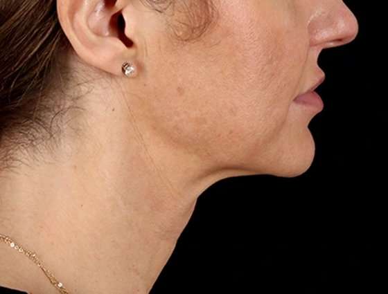 Neck Lift Before & After Patient #6676