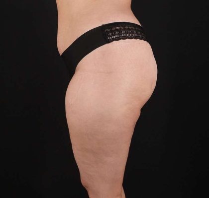 Liposuction Before & After Patient #1249