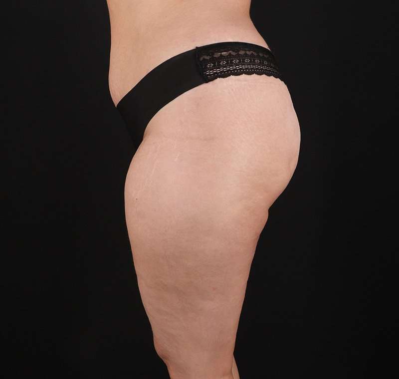 Liposuction Before & After Patient #1249