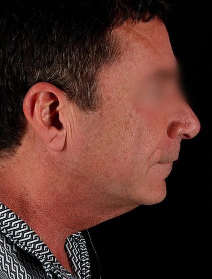 Neck Lift Before & After Patient #6698