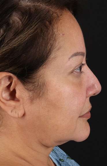 Neck Lift Before & After Patient #6709