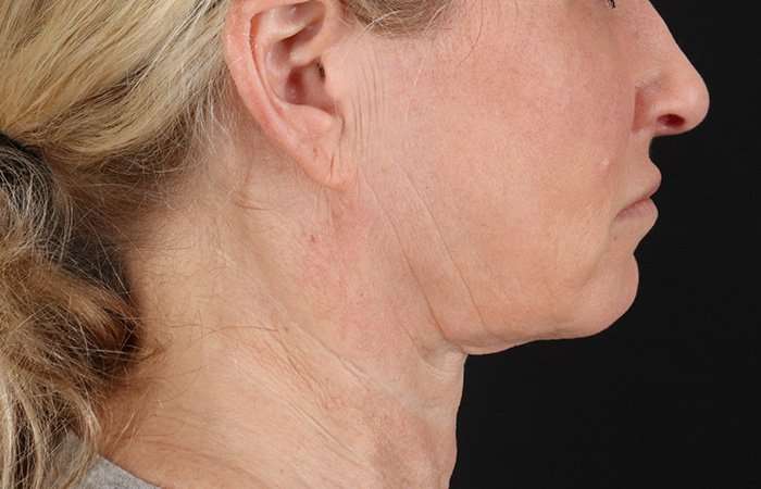 Neck Lift Before & After Patient #6731