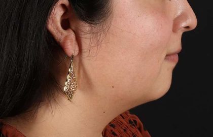 Neck Lift Before & After Patient #6743