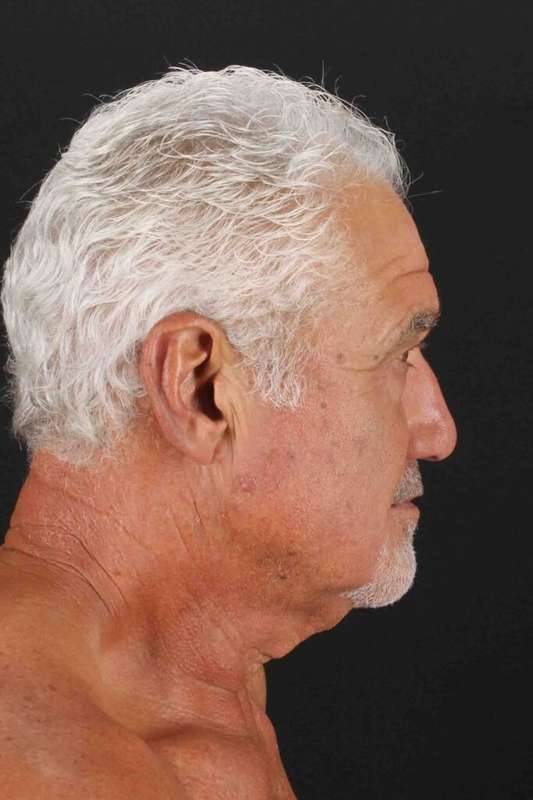 Neck Lift Before & After Patient #6788