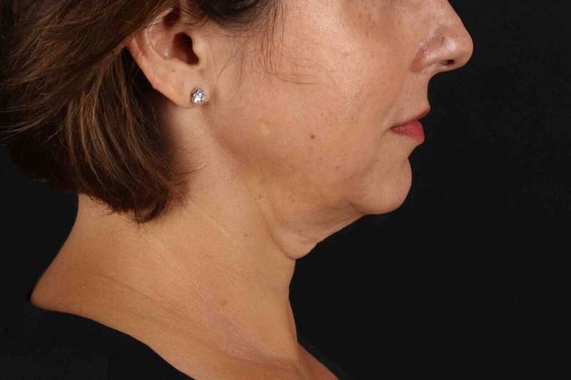 Neck Lift Before & After Patient #6797