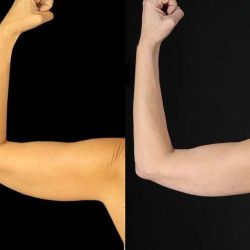 Liposuction Before & After Patient #1256