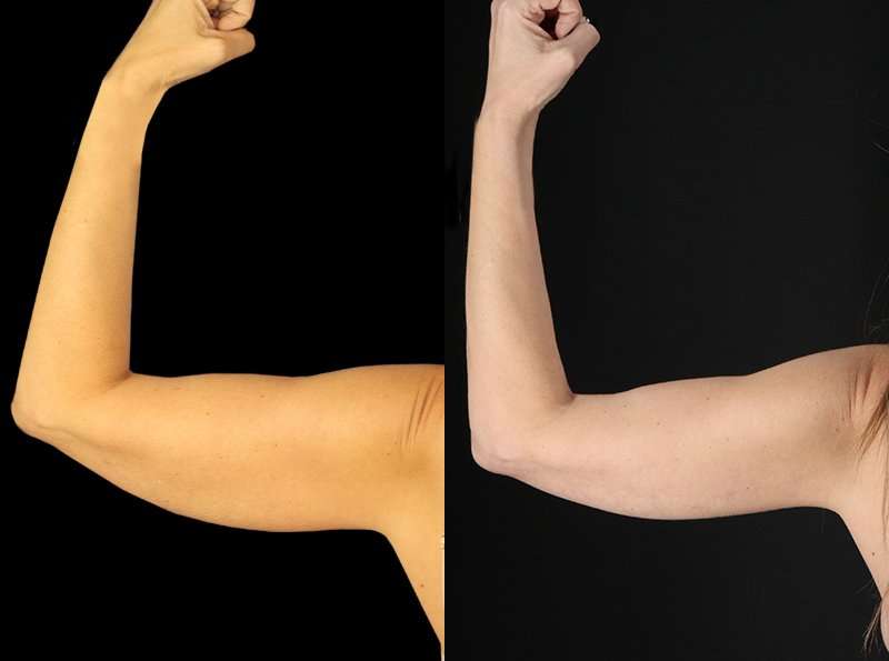 Liposuction Before & After Patient #1256