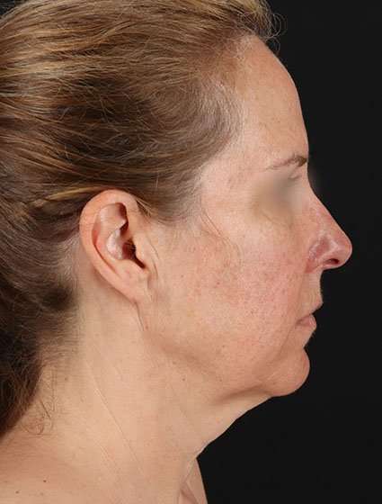 Neck Lift Before & After Patient #6838