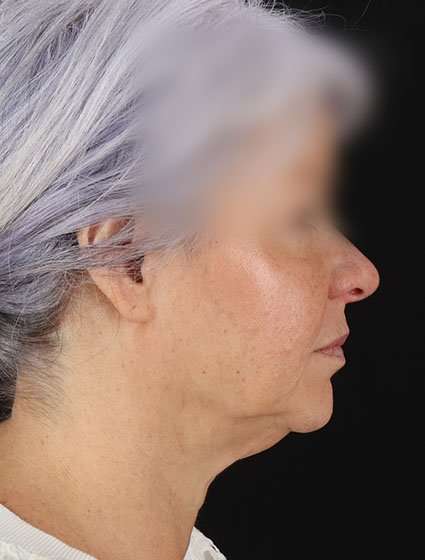 Neck Lift Before & After Patient #6878
