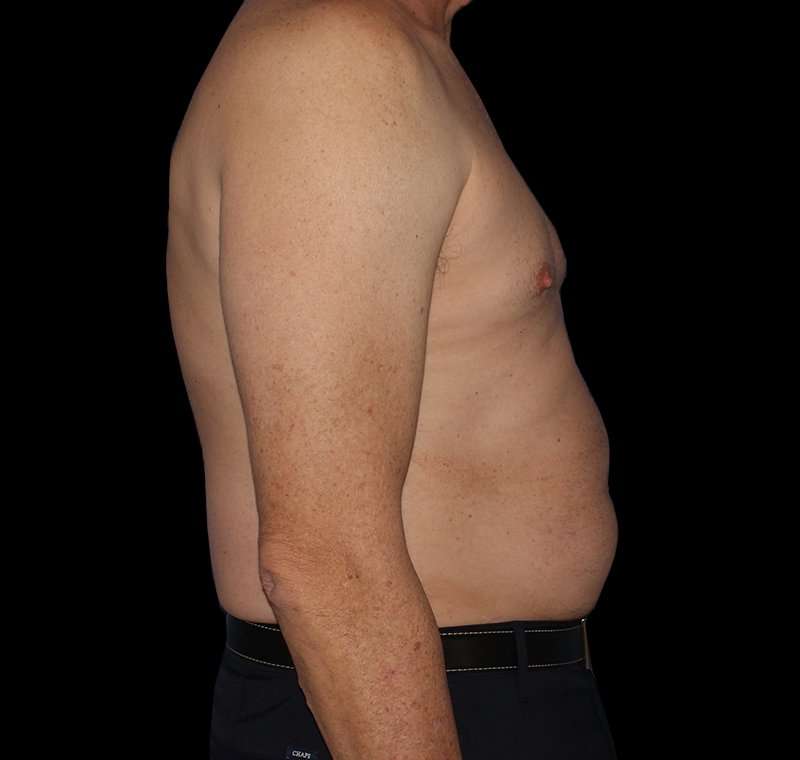Liposuction Before & After Patient #1270