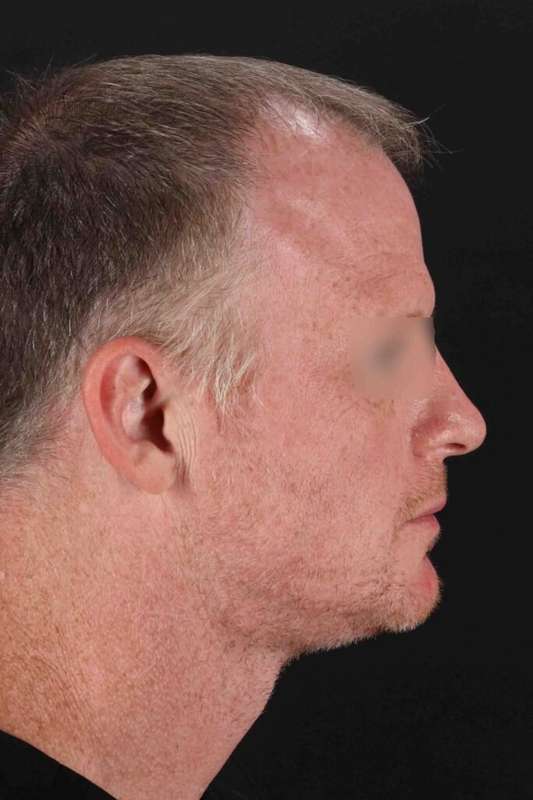 CO2 Laser Before & After Patient #6931