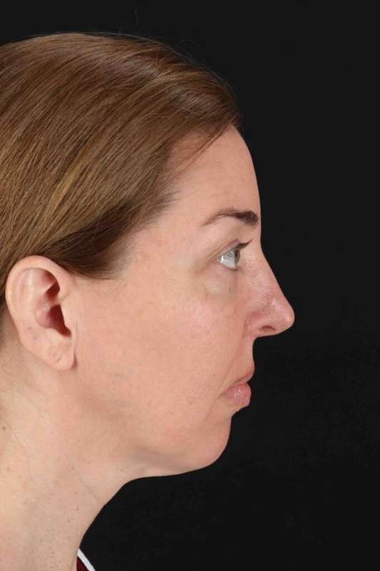 CO2 Laser Before & After Patient #6953