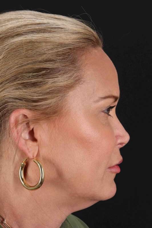 CO2 Laser Before & After Patient #6964