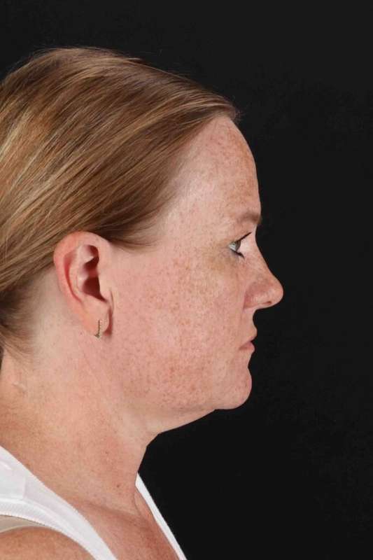 CO2 Laser Before & After Patient #6997