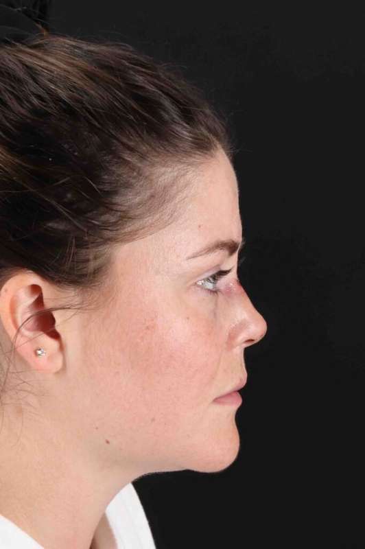 CO2 Laser Before & After Patient #7008