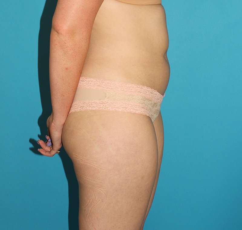 Liposuction Before & After Patient #1281