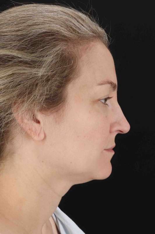 CO2 Laser Before & After Patient #7019
