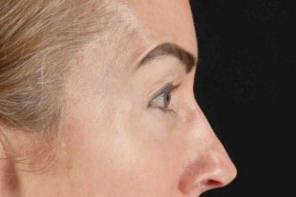 CO2 Laser Before & After Patient #7030