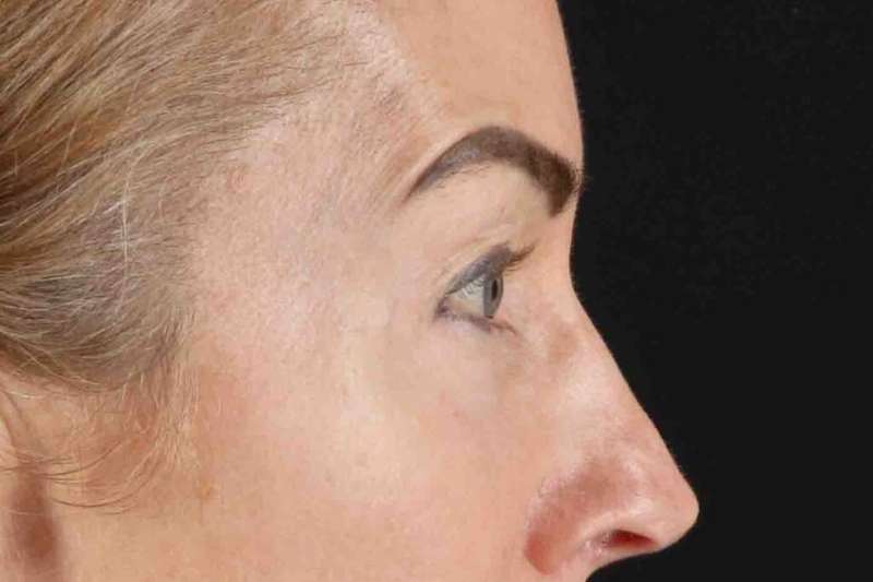 CO2 Laser Before & After Patient #7030
