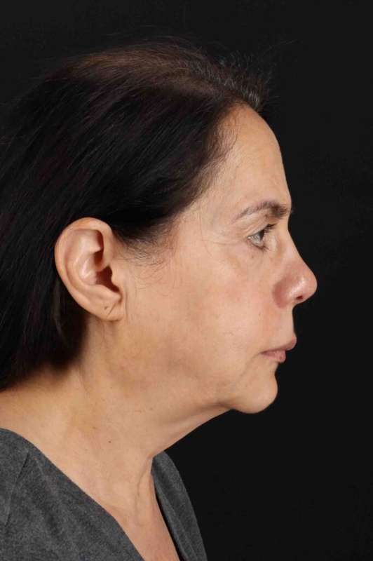 CO2 Laser Before & After Patient #7041