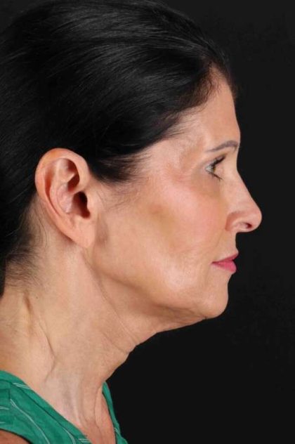 CO2 Laser Before & After Patient #7063
