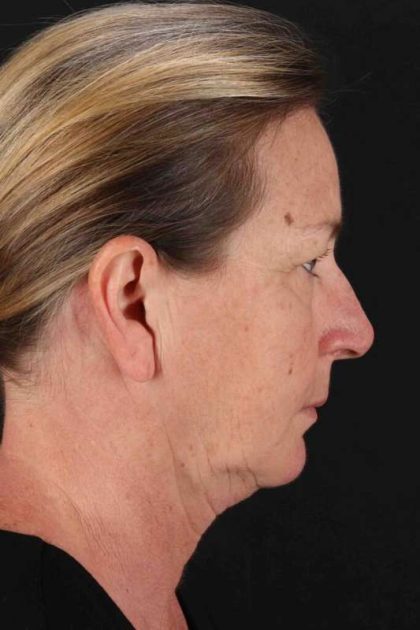 CO2 Laser Before & After Patient #7074