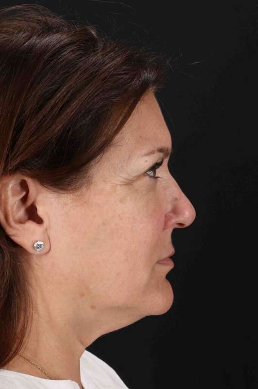 CO2 Laser Before & After Patient #7085