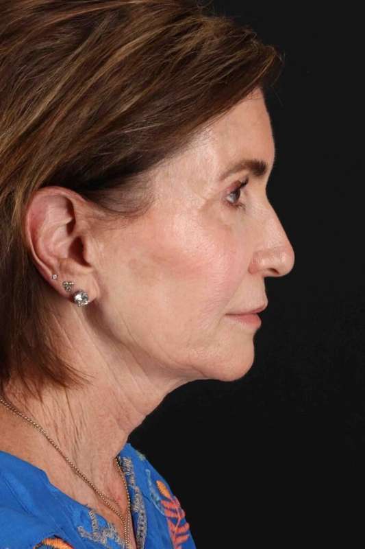 CO2 Laser Before & After Patient #7096