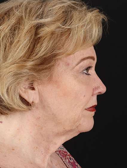 CO2 Laser Before & After Patient #7106