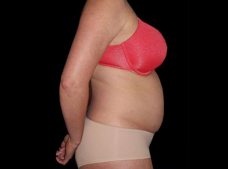 Liposuction Before & After Patient #1298