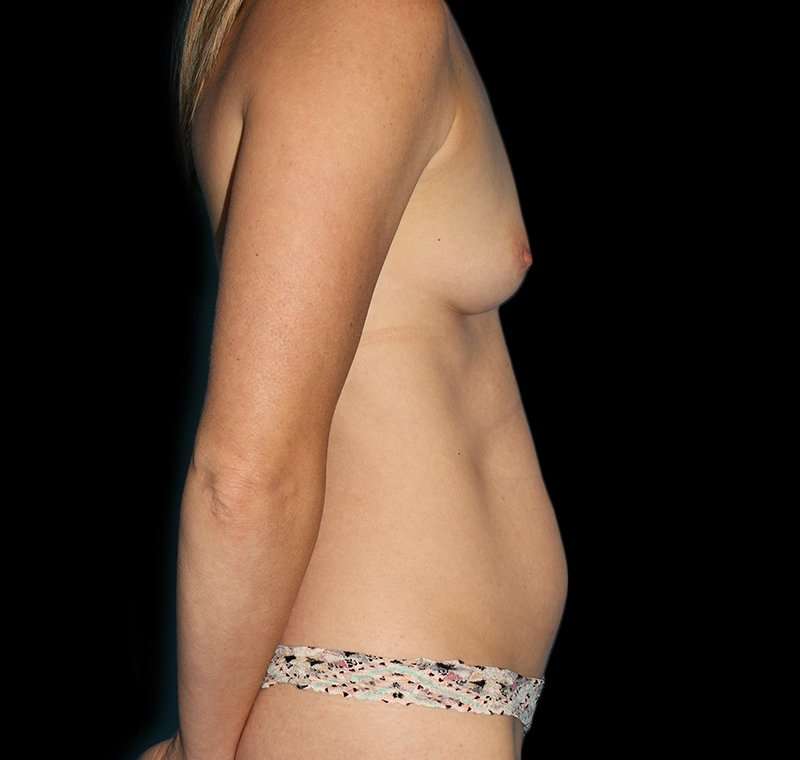 Liposuction Before & After Patient #1321