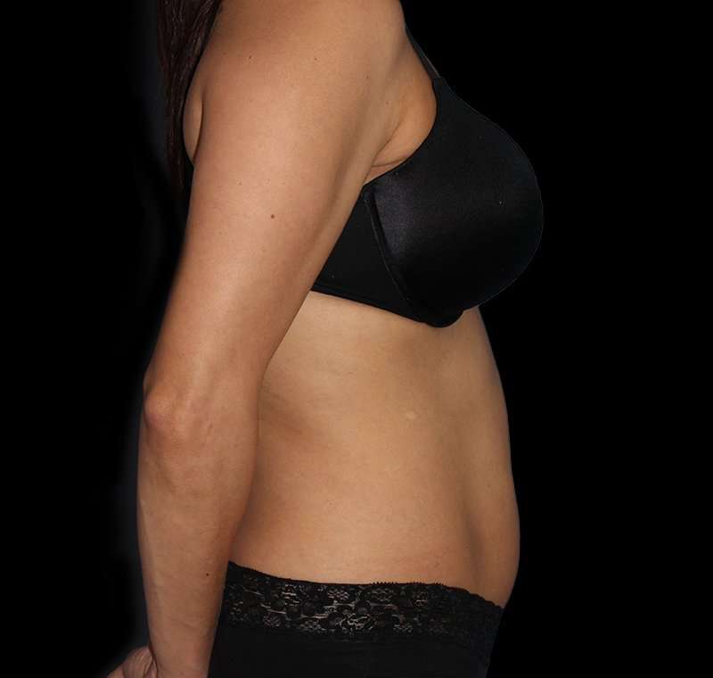 Liposuction Before & After Patient #1332