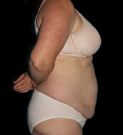 Abdominoplasty (Tummy Tuck) Before & After Patient #625