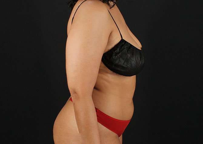 Liposuction Before & After Patient #1469