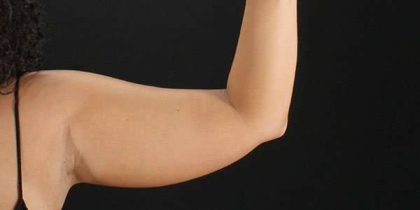 Liposuction Before & After Patient #1482