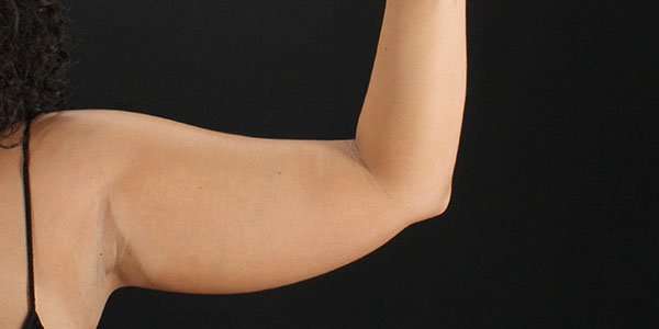 Liposuction Before & After Patient #1482
