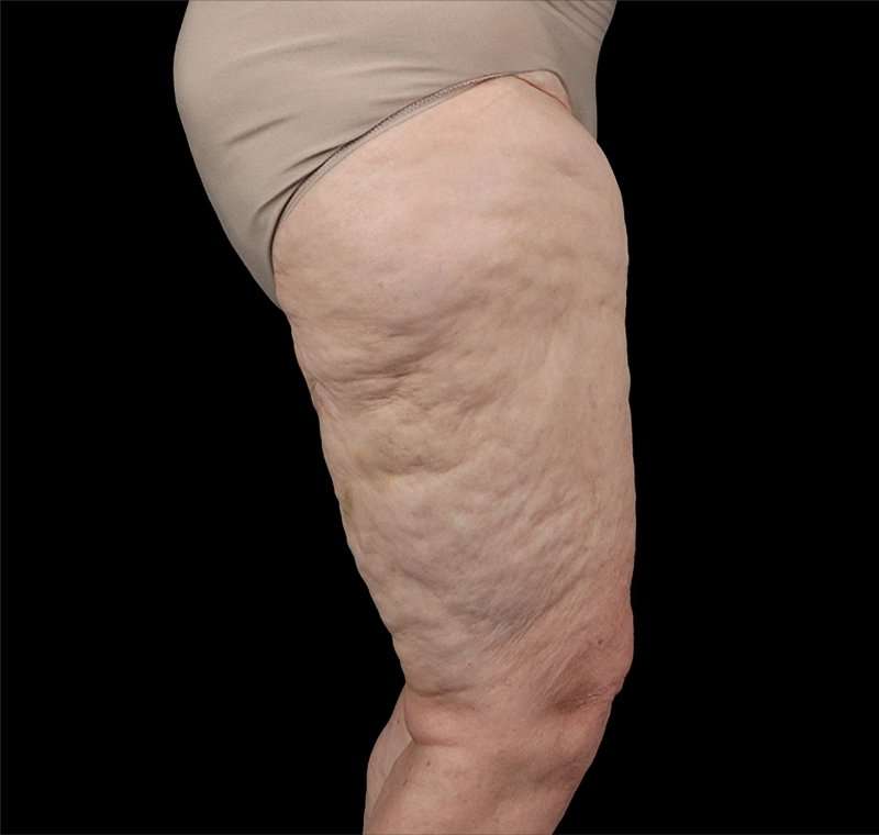 Liposuction Before & After Patient #1495