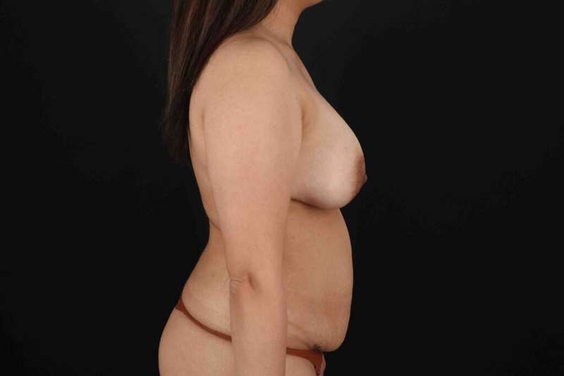 Abdominoplasty (Tummy Tuck) Before & After Patient #640