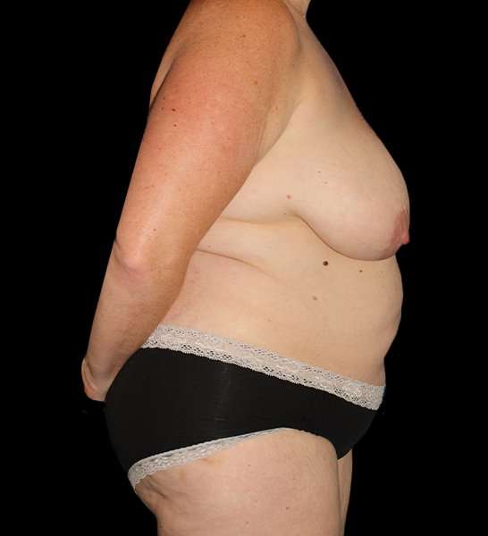 Mommy Makeover Before & After Patient #1535
