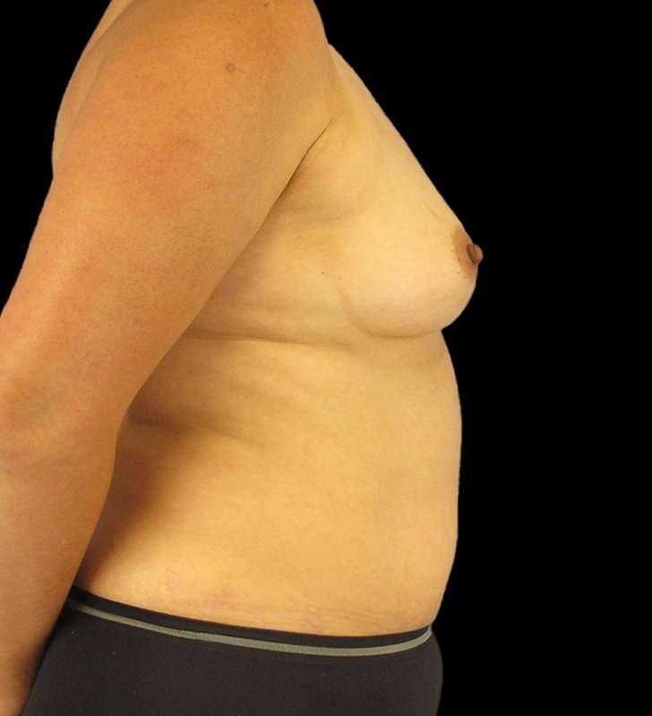 Mommy Makeover Before & After Patient #1547