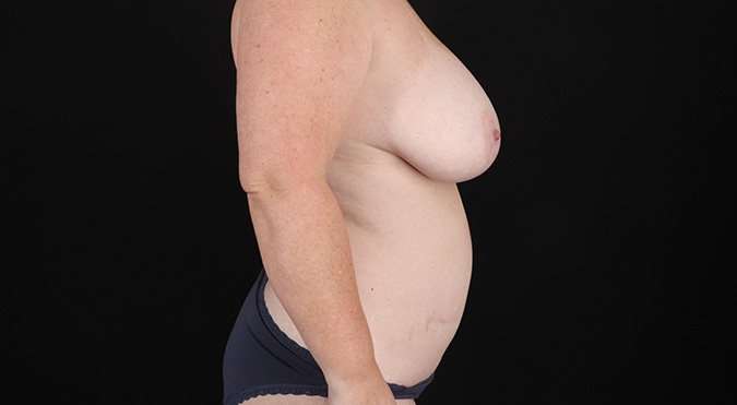 Mommy Makeover Before & After Patient #1597