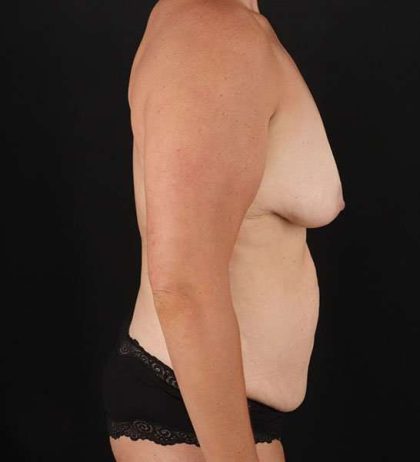 Abdominoplasty (Tummy Tuck) Before & After Patient #653