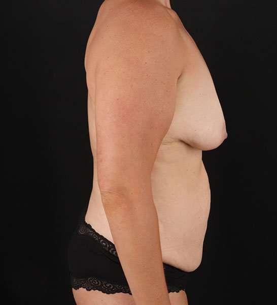 Abdominoplasty (Tummy Tuck) Before & After Patient #653