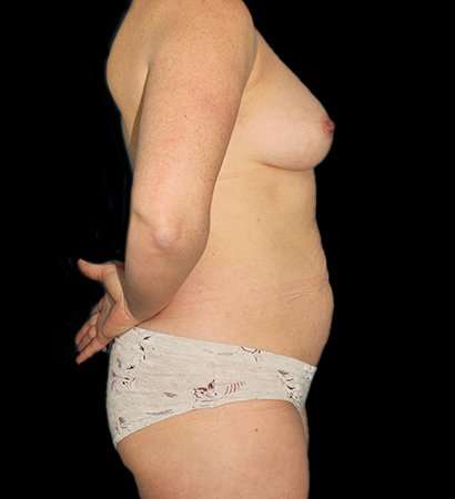 Mommy Makeover Before & After Patient #1738