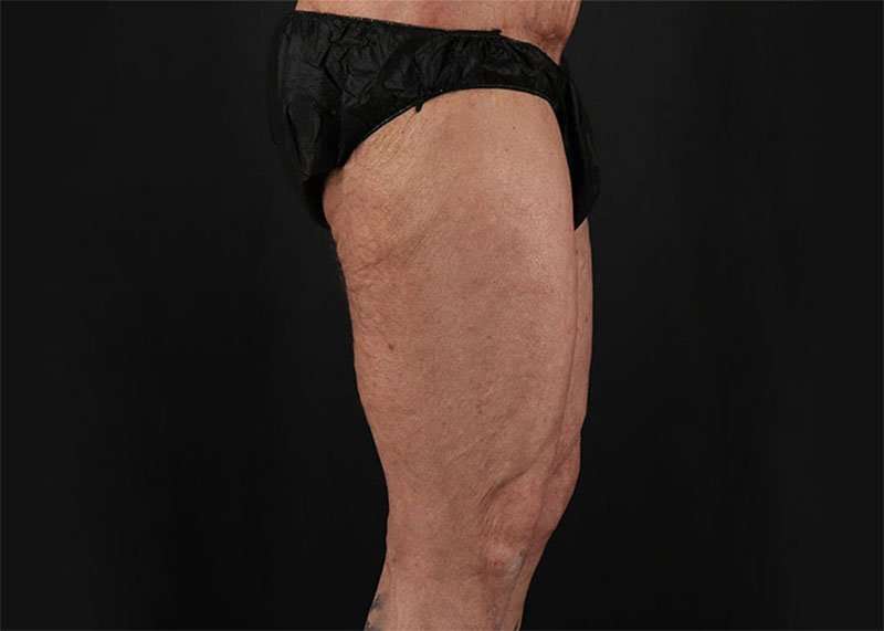 Thigh Lift Before & After Patient #1776
