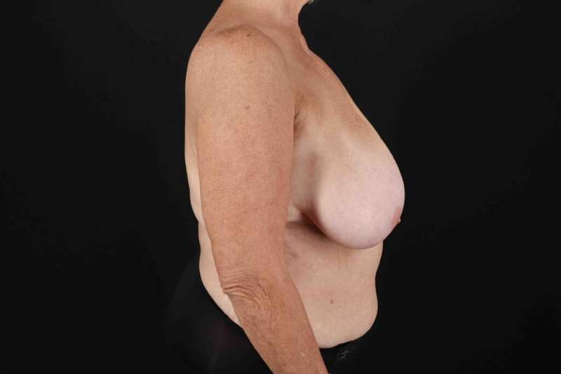 Abdominoplasty (Tummy Tuck) Before & After Patient #664