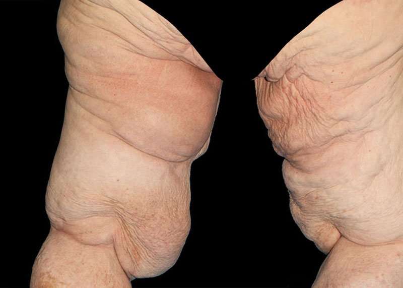 Thigh Lift Before & After Patient #1790