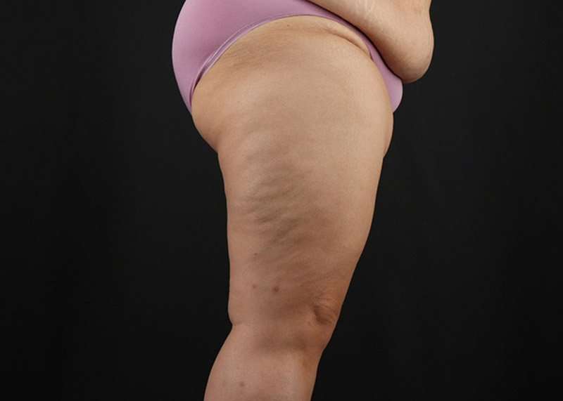 Thigh Lift Before & After Patient #1804