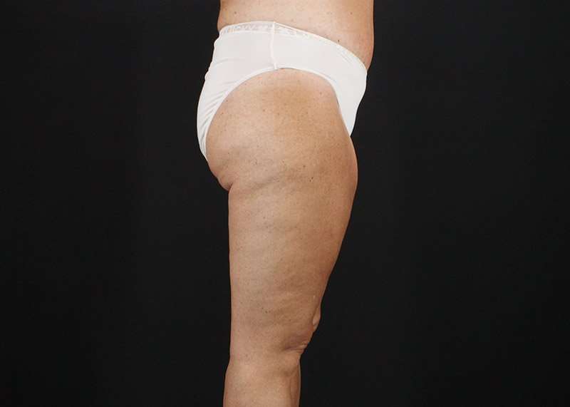 Thigh Lift Before & After Patient #1818