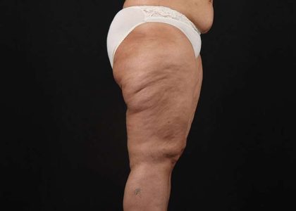 Thigh Lift Before & After Patient #1831
